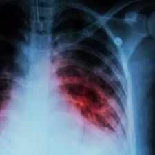Ministry of Health Care: Mortality from tuberculosis fell by 20%, infant mortality by 13%