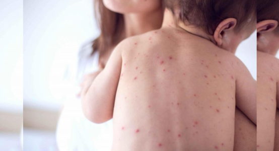 28 measles cases recorded in Almaty since beginning of 2020