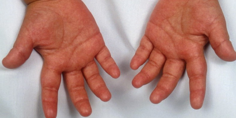 39 детей после перенесенного COVID-19 заболели кавасаки-подобным синдромом в Казахстане