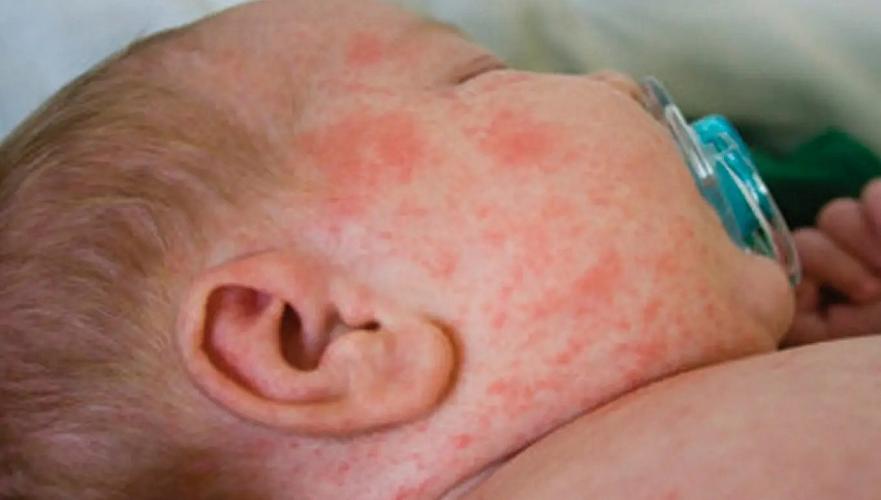 30 children with measles are in intensive care, half of them are under the age of one