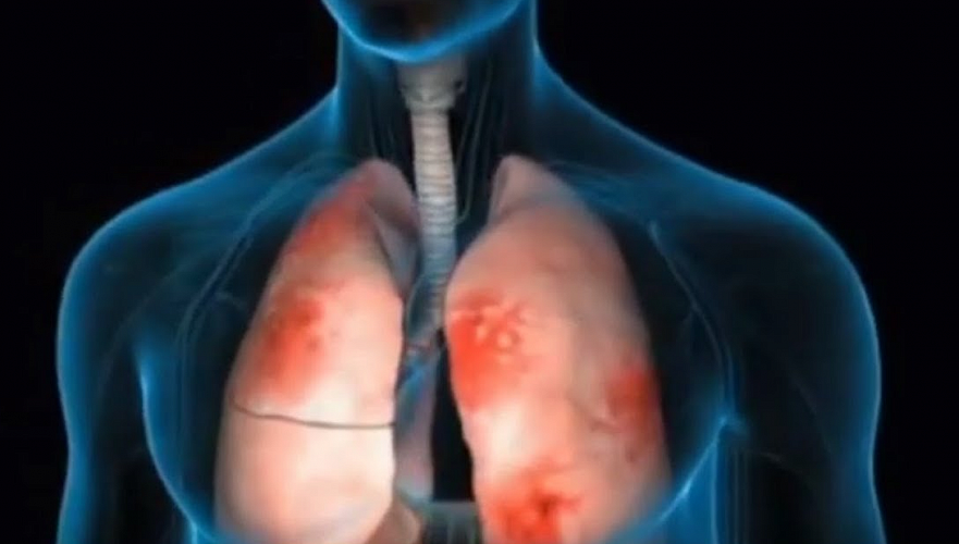 137 человек умерли за неделю от пневмонии с признаками коронавируса в Казахстане