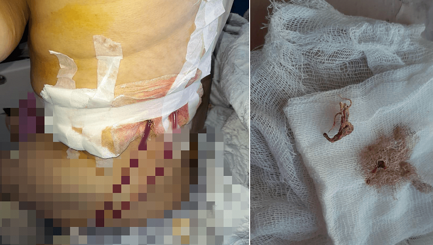 Забытый после операции кусок марли гнил почти полтора года в организме жителя Жезказгана