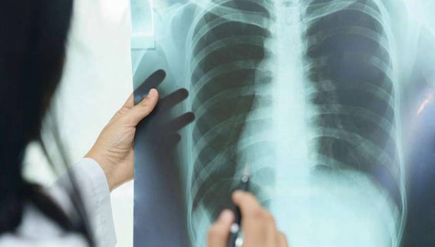 Число больных туберкулезом резко возросло в Экибастузе после закрытия социальной столовой
